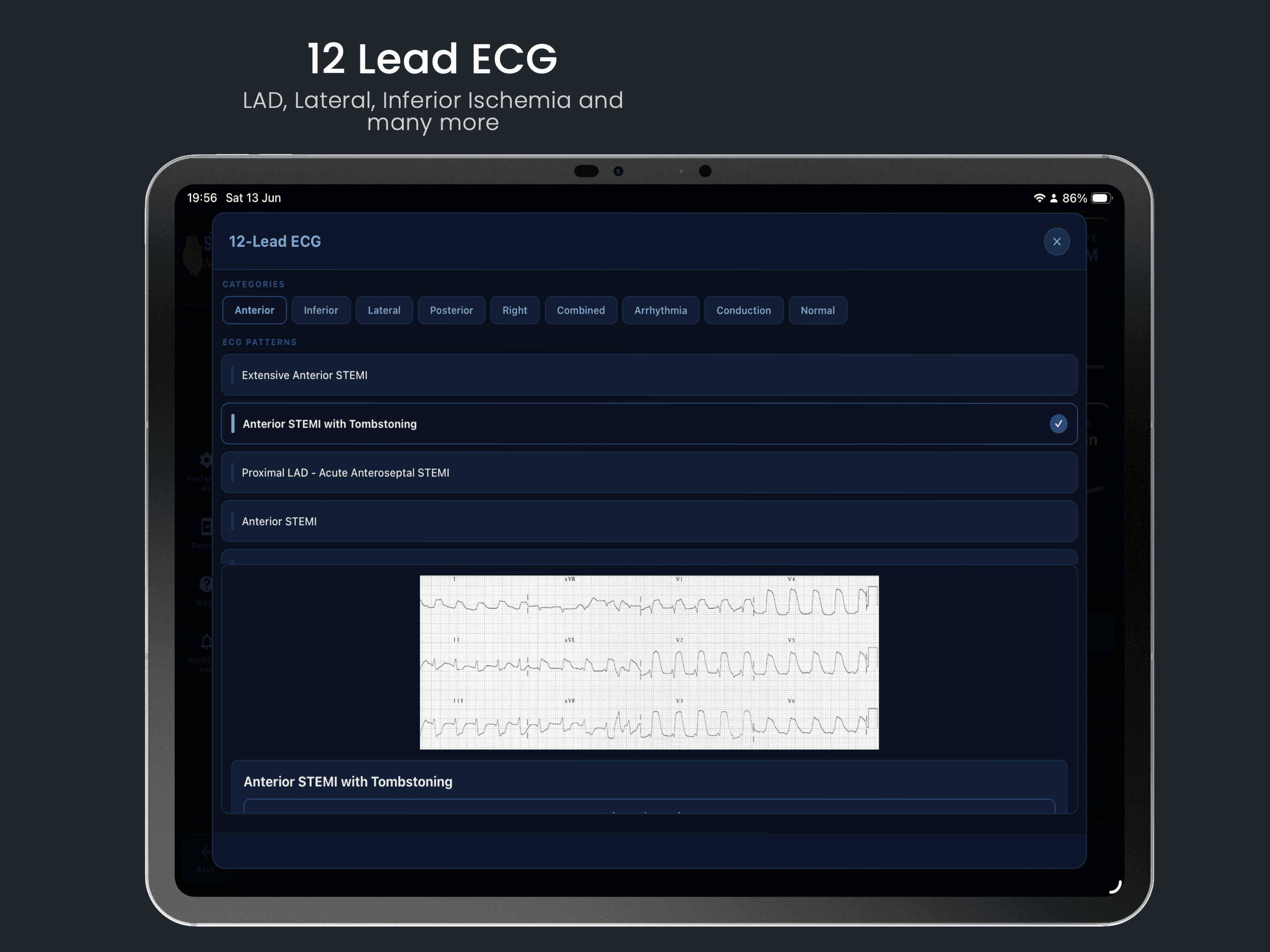 12 Lead ECG — LAD, Lateral, Inferior Ischemia and many more